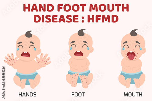 HFMD children infected. Hand-foot-mouth disease Infographics with symptoms. cartoon health concept vector illustration.