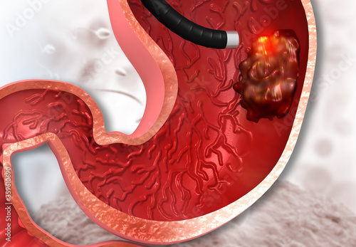 Stomach cancer, gastric cancer, cancer treatment. 3d illustration..