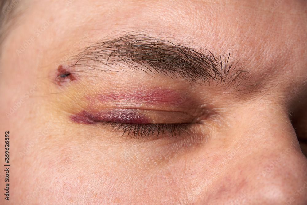 Obraz premium close view of a black eye, man's face with a hematoma