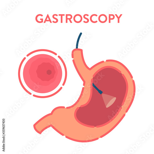 Gastroscopy procedure equipment for stomach disease diagnostics. Gastrointestinal tract examination with endoscope. Medical concept. Vector illustration in flat style. 