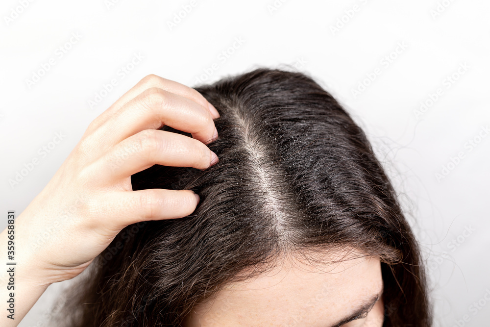 Obraz premium The woman scratches her head with her hand, showing a parting of dark hair with dandruff. Close up. The view from the top. White background. The concept of dandruff and pediculosis