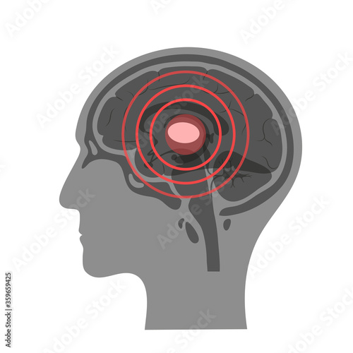 Pain Brain Illustration