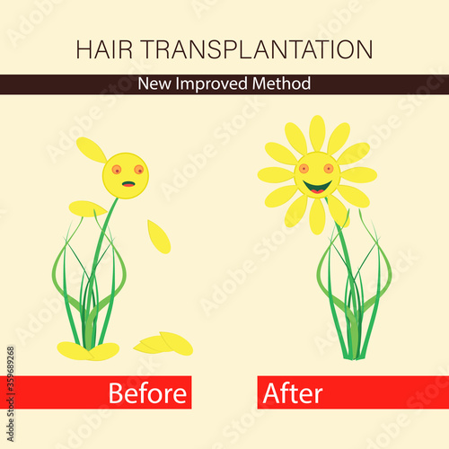 Hair transplantation. Treatment of baldness and alopecia. Template advertising banner. Hairless and hairy flower. Before and after. Vector illustration.
