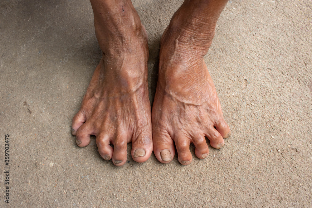 Foot Seniors. dirty feet on mortar. toenail fungus.