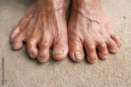 Foot Seniors. dirty feet on mortar. toenail fungus.