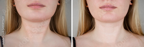 Fotografie Photos before and after plastic surgery to remove Venus rings