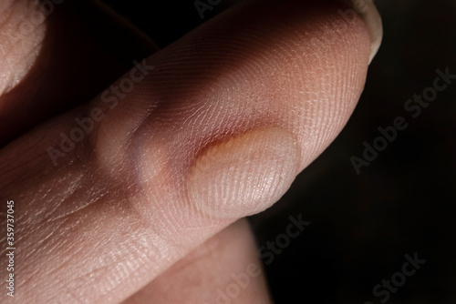 Valokuva Big corn close up on index finger in woman