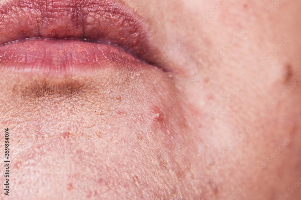Female face with acne skin problem Female face with acne skin problem