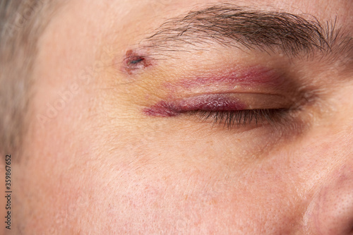 close view of a black eye, man's face with a hematoma
