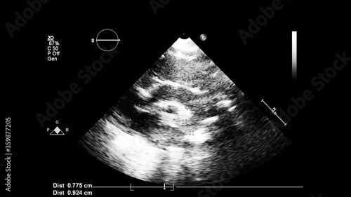 Image of the heart in gray-scale mode during transesophageal ultrasound. © faustasyan