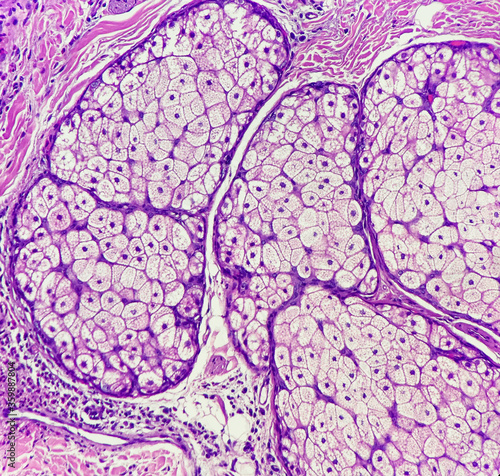 Photo of benign sebaceous glands. These glandular cells possess bland round nuclei with vacuolated cytoplasm. photo