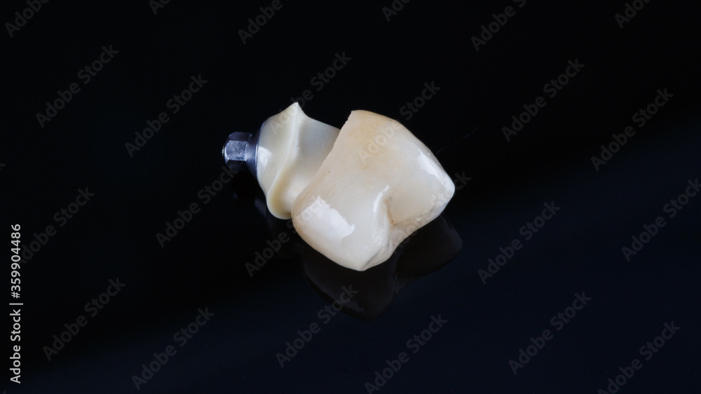 dental crown made of ceramics and connection with the abutment from zercon, shot on a black background dental crown made of ceramics and connection with the abutment from zercon, shot on a black background
