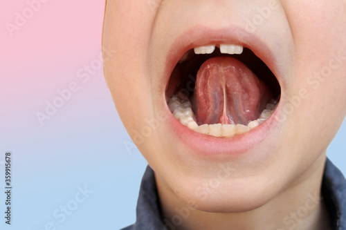 boy, kid performs articulation exercises for mouth, concept of speech disorders, correction, frenum of tongue, methods of correctional developmental exercises
