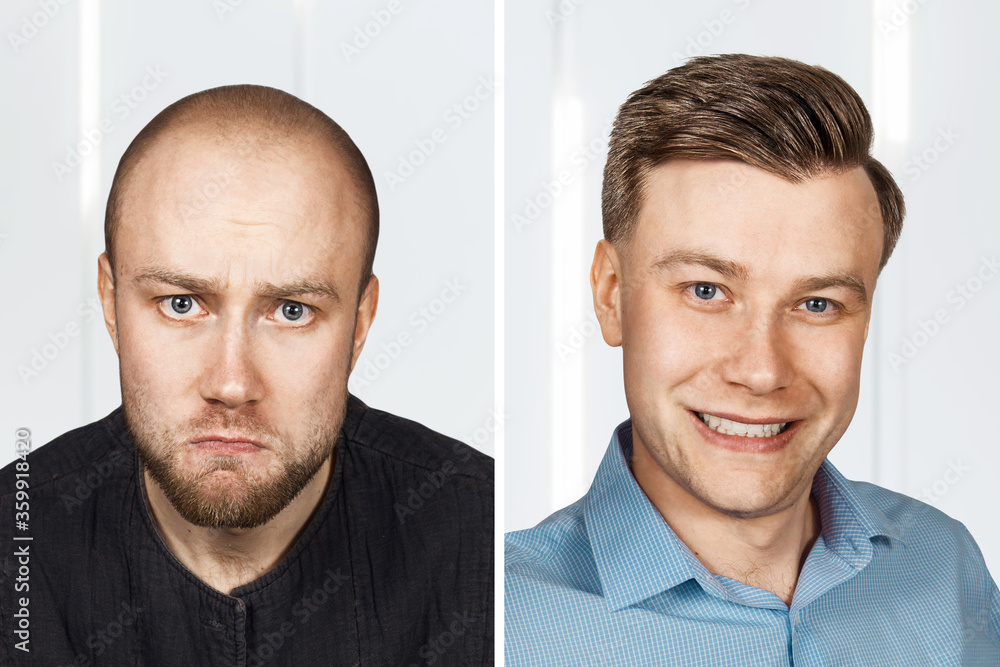 bald Man before and after transplant hair and alopecia bald Man before and after transplant hair and alopecia