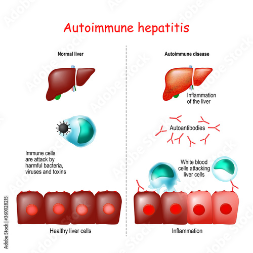 Autoimmune hepatitis