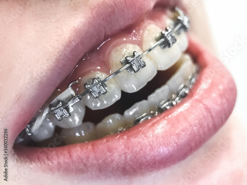 Mouth with brackets braces in medical concept