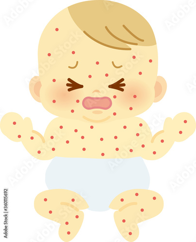全身に発疹が出たおしめ姿の赤ちゃん　ベビー全身イラスト23