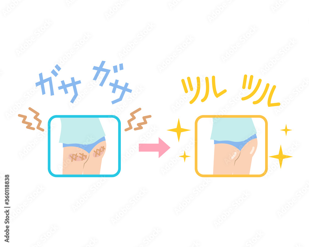 お尻の黒ずみや角質がツルツルになったイラスト Stock Vector Adobe Stock お尻の黒ずみや角質がツルツルになったイラスト Stock Vector Adobe Stock