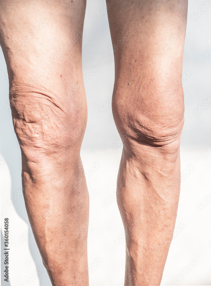 Leg and knee of an old man with synovial problems on a white background Leg and knee of an old man with synovial problems on a white background