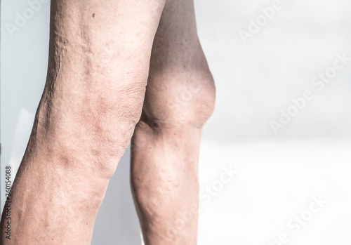 Leg and knee of an old man with synovial problems on a white background