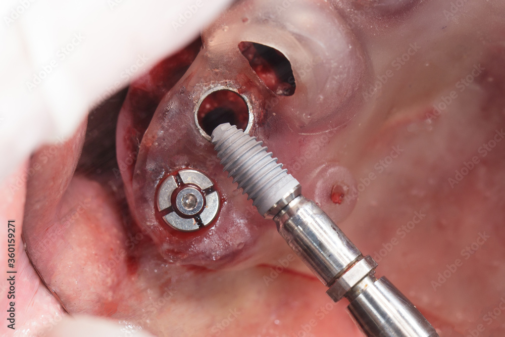Fototapeta premium implantation through a surgical template during surgery