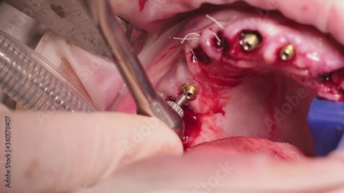 installation of dental multi-units after implantation for prosthetics of the upper jaw