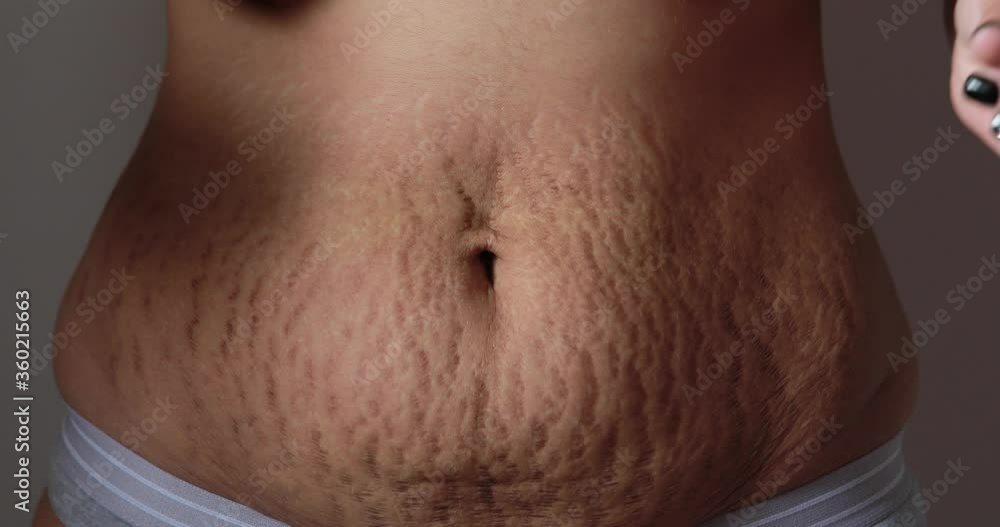 Pregnancy close up of Woman belly skin with heavy stretch wrinkle marks and loose skin after giving birth - Health care and rehabilitation for skin and body shape concept Pregnancy close up of Woman belly skin with heavy stretch wrinkle marks and loose skin after giving birth - Health care and rehabilitation for skin and body shape concept