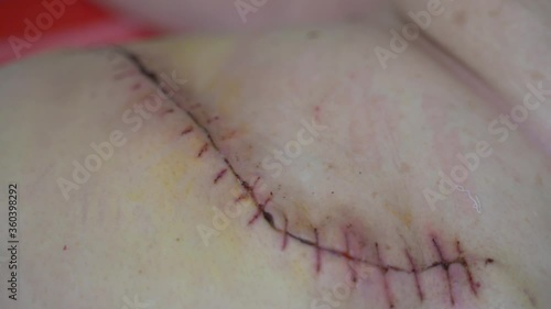 Close up of obese woman abdomen with scar and stitches after surgical operation. photo