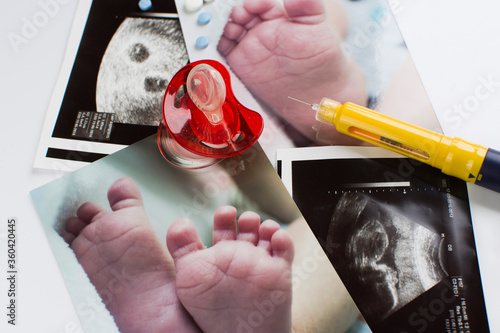 Ultrasonogram picture and baby feet pictures - twin pregnancy.