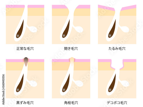 毛穴の悩み　肌の断面図　セット