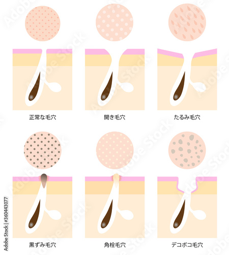 毛穴の悩み　肌表面と断面図　セット