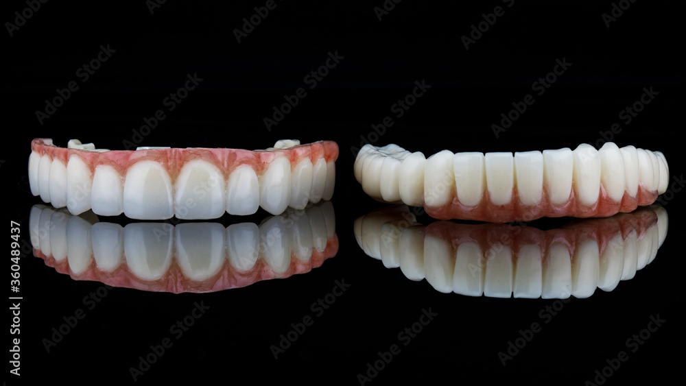 two high-quality dental prostheses for fixation on the upper and lower jaw of the patient after implantation two high-quality dental prostheses for fixation on the upper and lower jaw of the patient after implantation