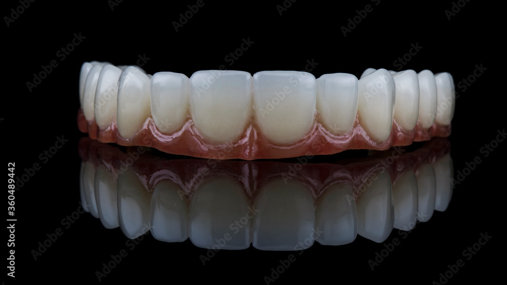 dental prosthesis made of polymer for fixation on the maxilla of the patient after implantation dental prosthesis made of polymer for fixation on the maxilla of the patient after implantation