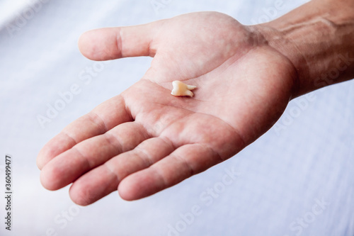 Human's tooth torn out after dentist surgery laying on the palm of the hand 