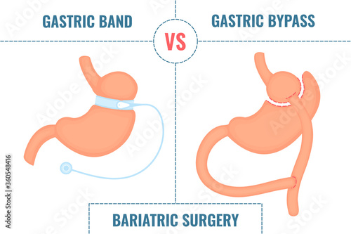 Adjustable gastric band vs gastric bypass. Bariatric surgery weight loss procedures comparison. Stomach reduction anatomical diagram infographics. Health care  medical concept. Vector illustration.