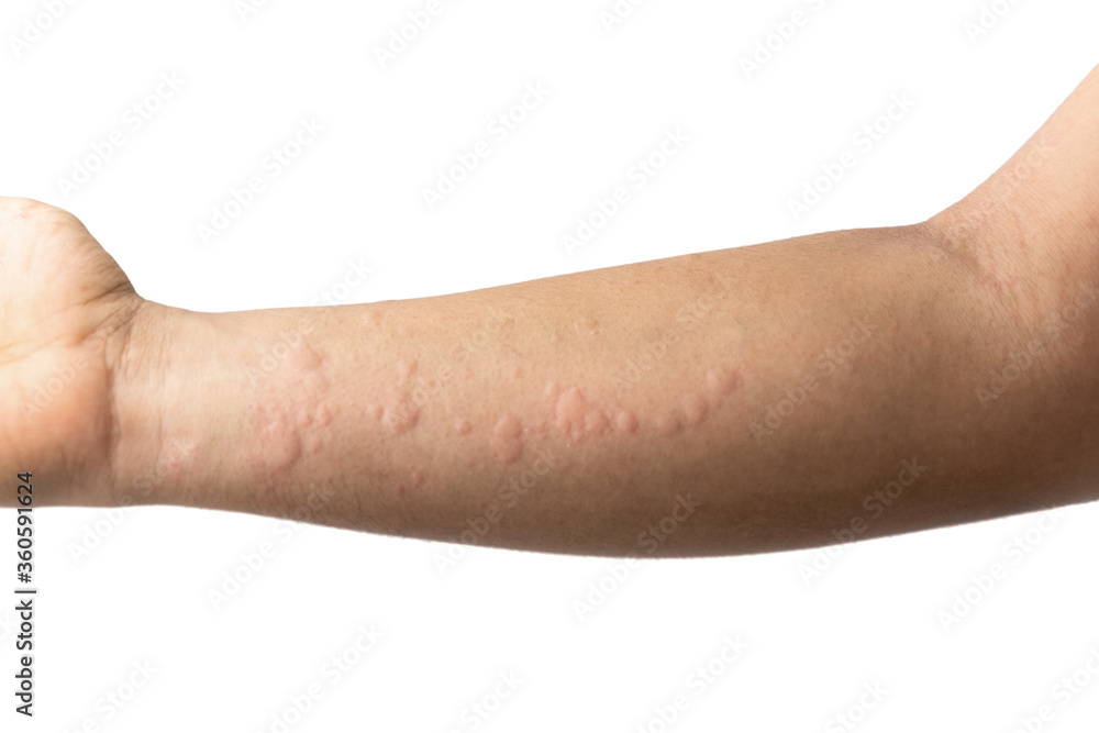 allergy on the male's hand against white background allergy on the male's hand against white background