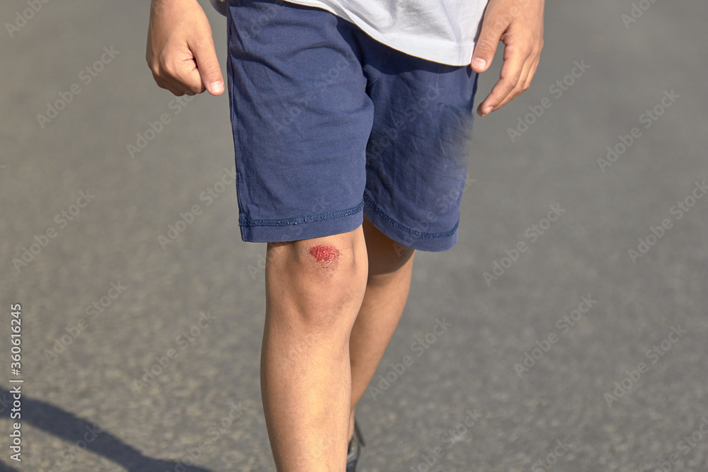 bruised wound on the knee, the boy fell and scratched his knee bruised wound on the knee, the boy fell and scratched his knee