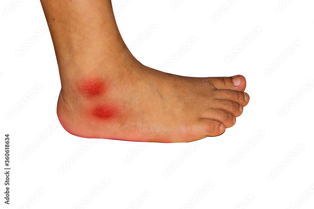 Astragalus has scratches, bruises as a result.point highlighted in red Astragalus has scratches, bruises as a result.point highlighted in red