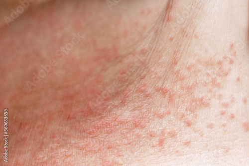 Skin disease prickly heat rash or miliaria on belly skin of woman. Healthcare skin cause for outdoor work in sunny with hot weather and have sweat. Dermatologist and treatment medication concept. © nicemyphoto