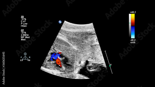 Ultrasound screen with fetal echocardiography