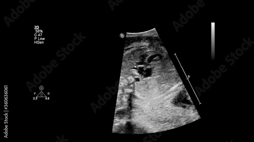 Ultrasound screen with fetal echocardiography