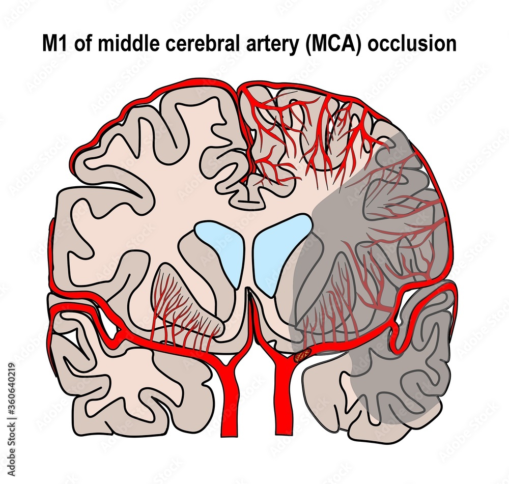 the illustration shown the proximal left M1 occlusion and large