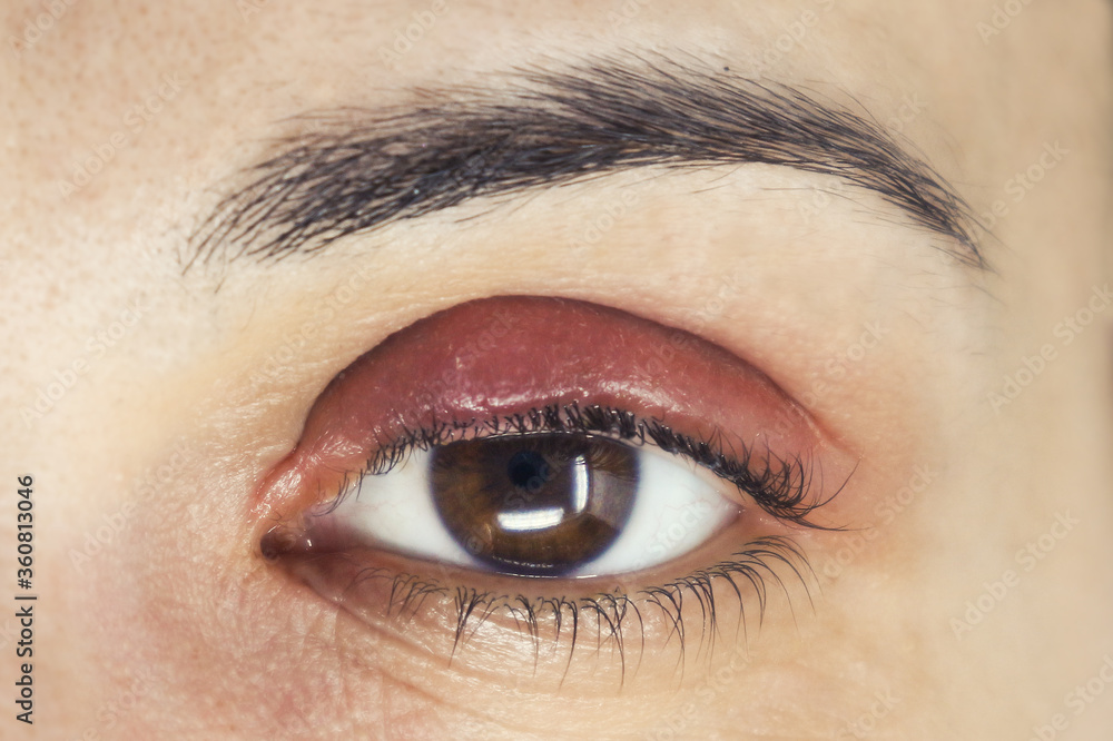 Swollen and inflamed eyelid due to an infection. Diagnosed as a ...