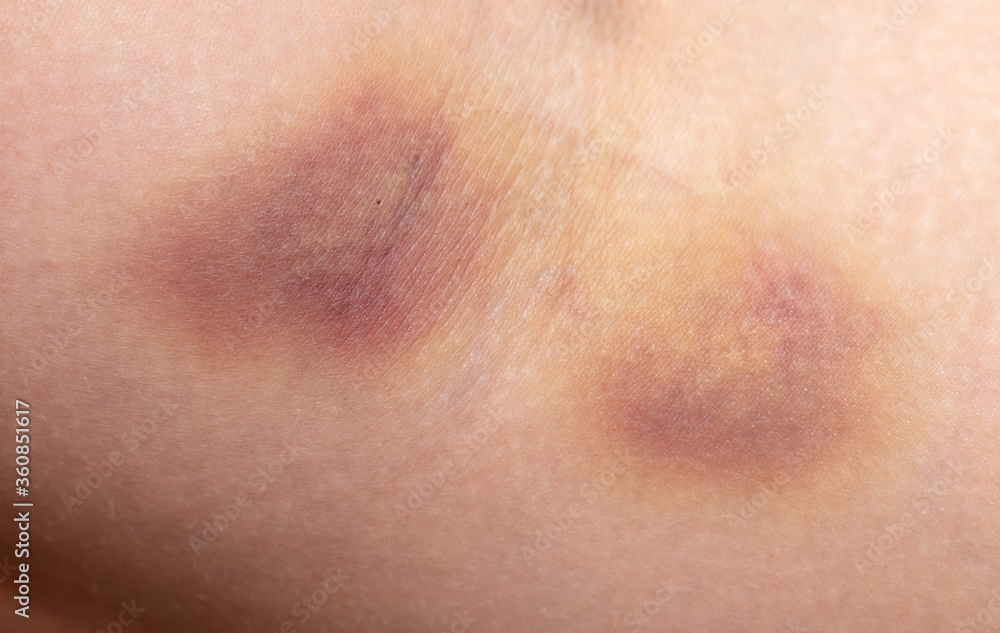 Closeup bruise on human skin as a background. Closeup bruise on human skin as a background.