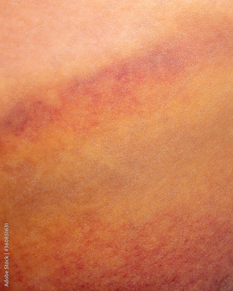 Closeup bruise on human skin as a background. Closeup bruise on human skin as a background.
