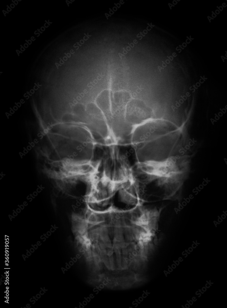 skull x ray skull x ray