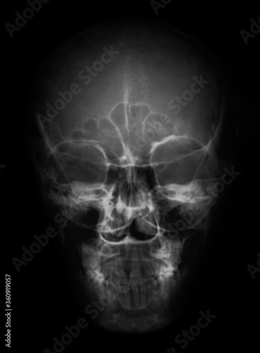 skull x ray