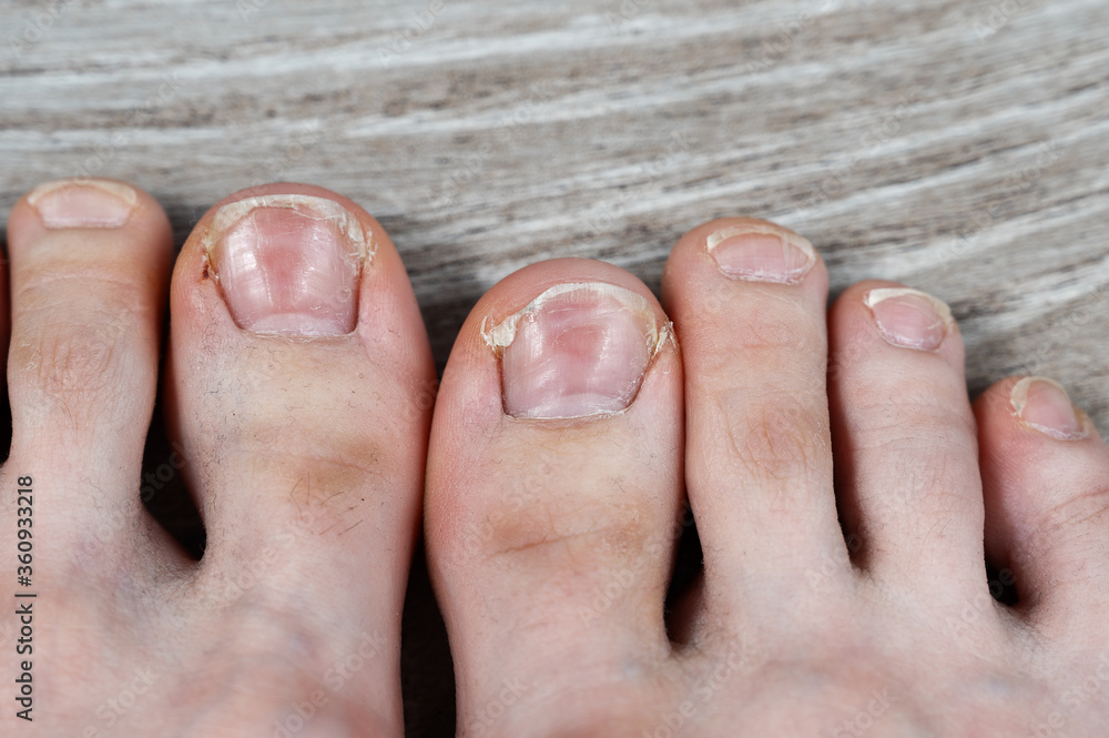 dirty toes with hair and ingrown cracked nails
