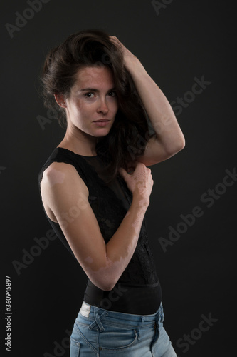 Vitiligo on the hands. Young beautiful woman with vitiligo. © muro