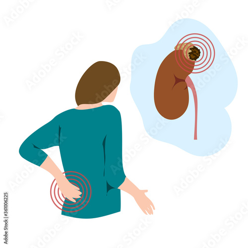 Adrenal gland tumor. Disease. Backache, woman with hand on her back, pain. Medical flat anatomy illustration.